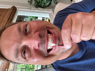 After whitening 2