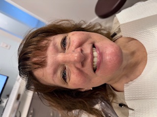 Before whitening 3