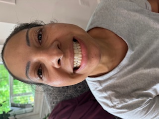 Before whitening 4